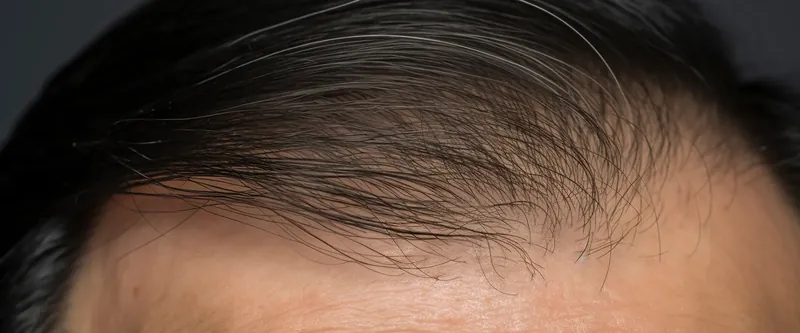 Close-up of hairline for hair restoration